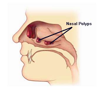 nasal polyps removal cost