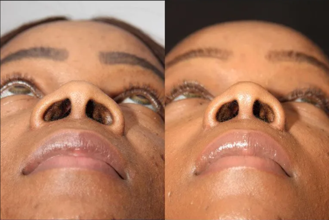 Adrenalectomy Treatment