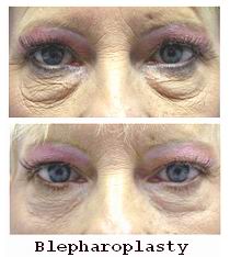 Blepharoplasty