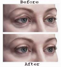 Blepharoplasty