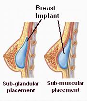 Breast Implant