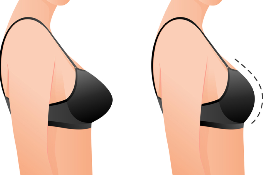 Breast Implant
