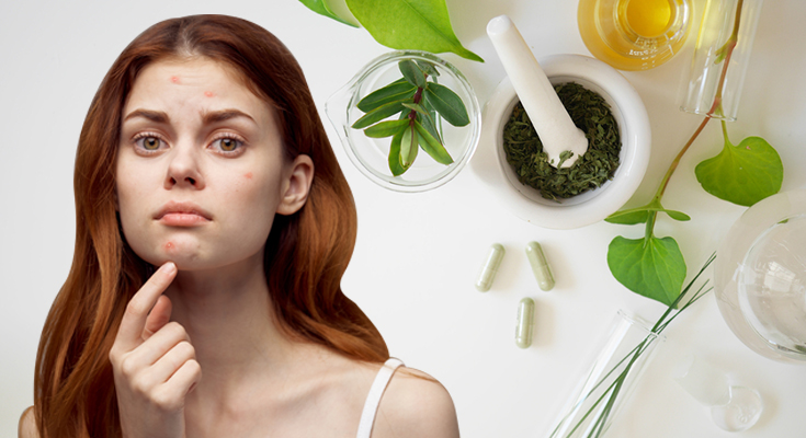 Acne Causes Image 1